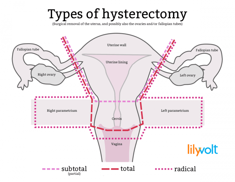 So What Is A Hysterectomy Anyway Lilyvolt 1462