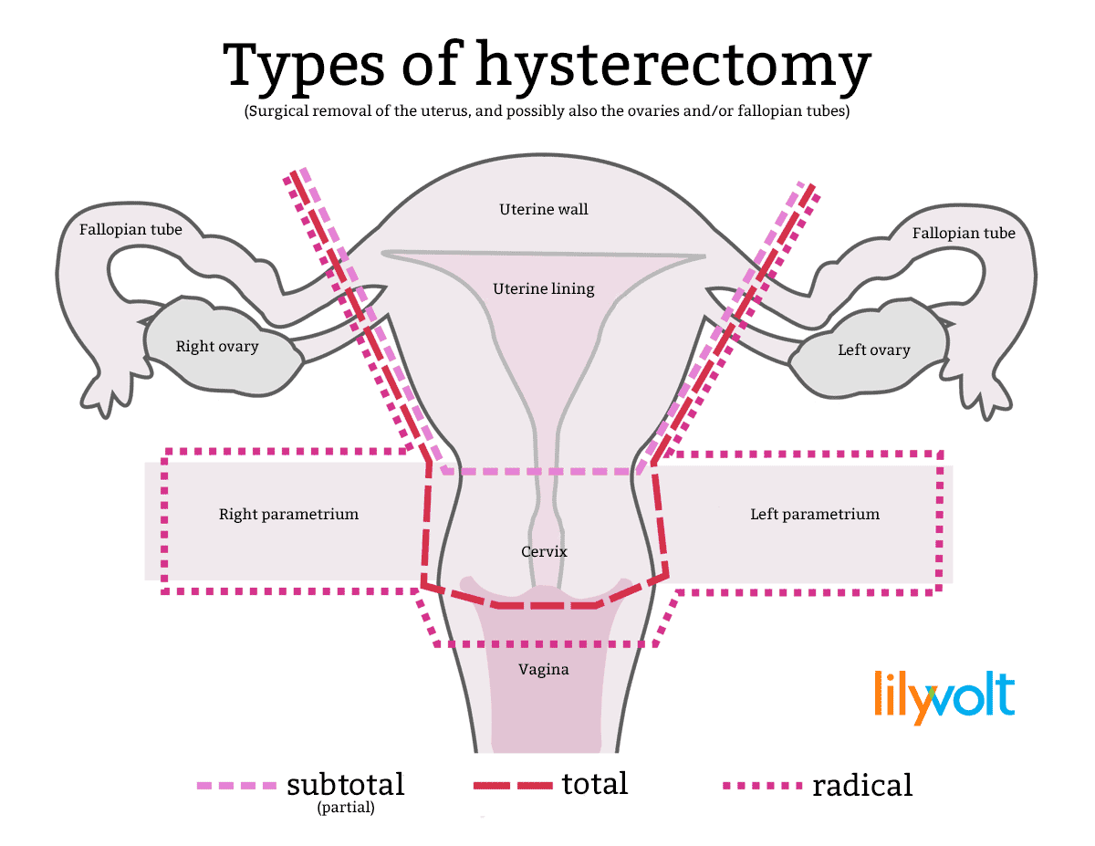 Hysterectomy types - Lilyvolt com