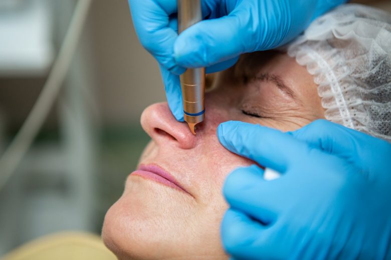 Laser treatment to remove blood vessels on face - Cosmetic procedure