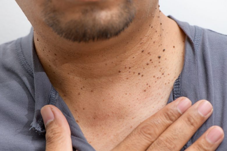 Man with dark skin tags on his neck