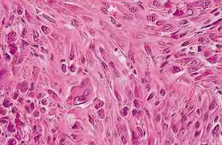 Uterine smooth muscle tumor with mild mitotic activity
